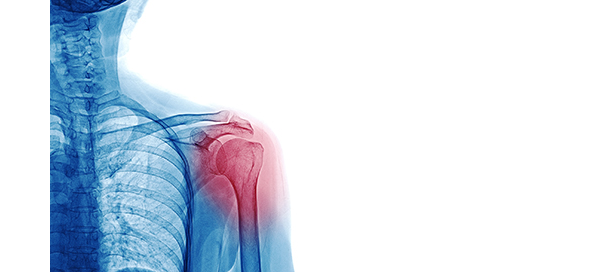 Musculoskeletal Disorders (MSD)